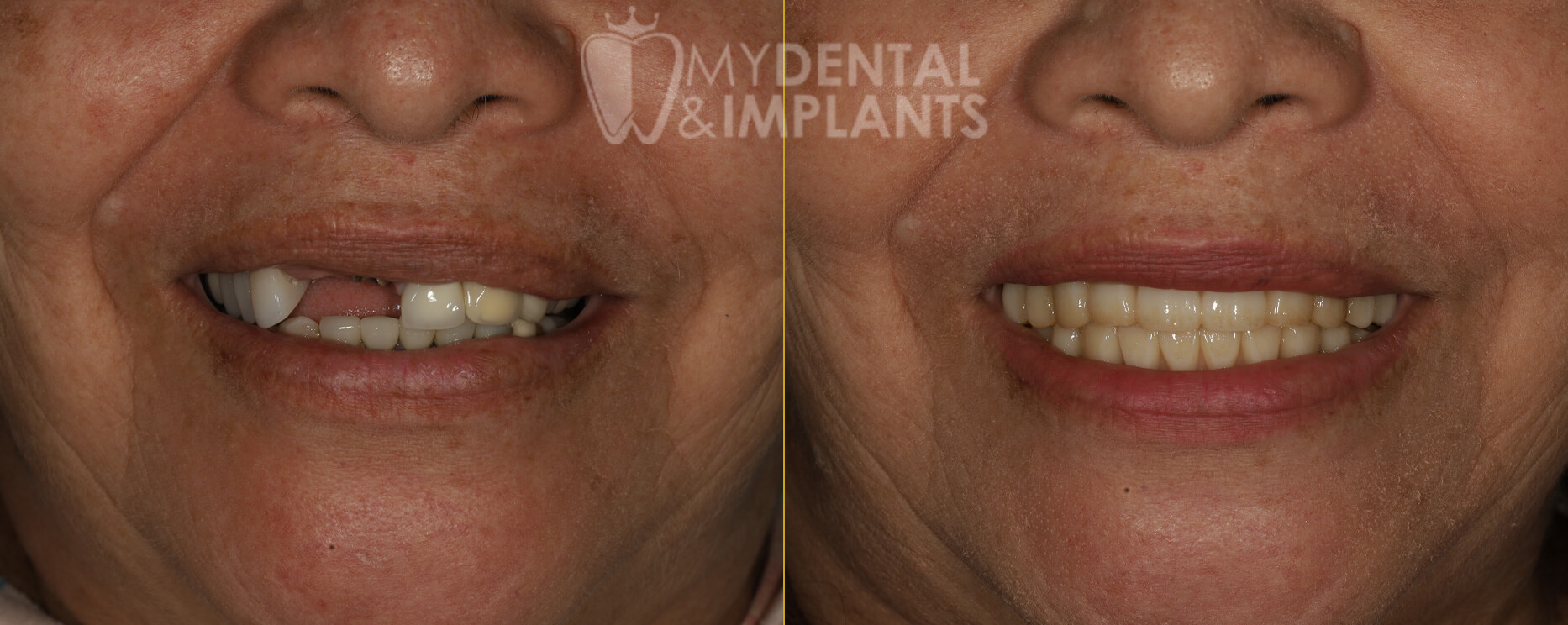 Before After Image