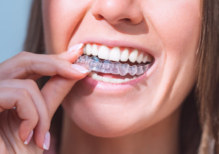 Invisalign